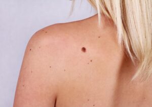 Hoe herkent u huidkanker? - MohsA Huidcentrum
